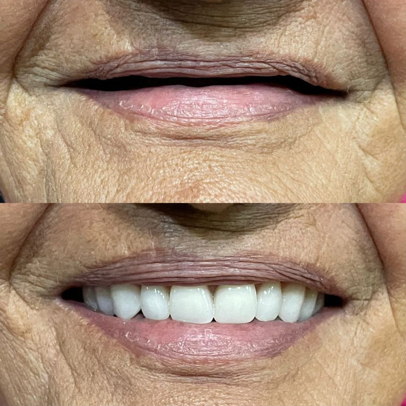 Antes e depois de reabilitação oral