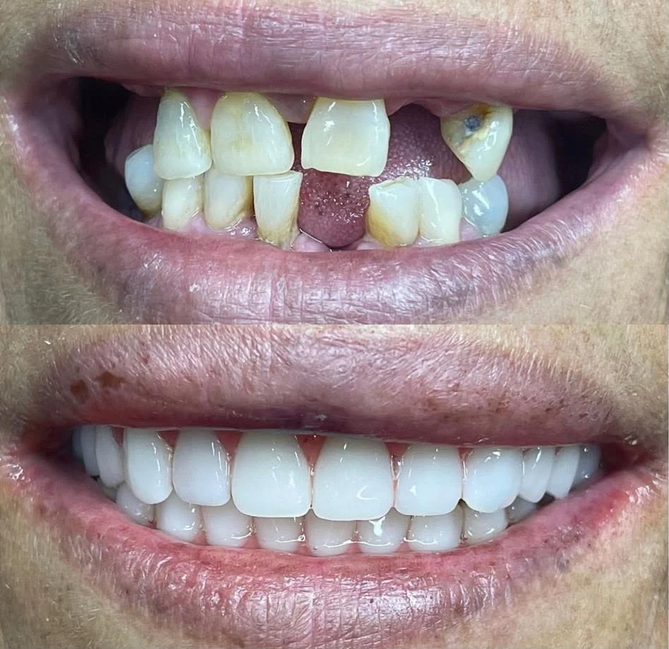 Antes e depois de reabilitação estética do sorriso